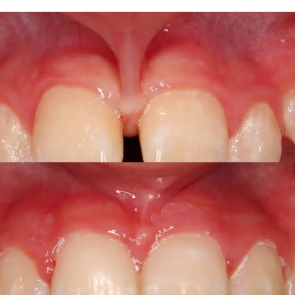 Spot and treat a lip tie