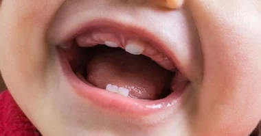 Spot and treat a lip tie