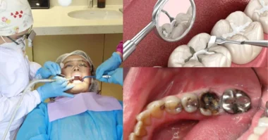 an image of teeth damage and filling