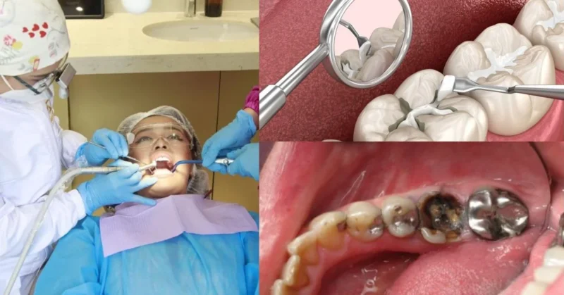 an image of teeth damage and filling