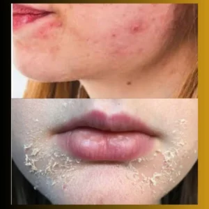 an image of Tretinoin Side Effects