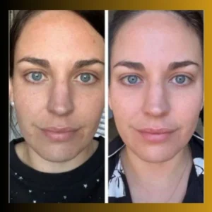 an image of Tretinoin’s Skin Benefits